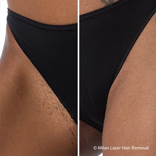 Before and after preview for bikini